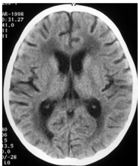 Fig. 1. 8.4-year-old male patient with acute lymphoblastic leukemia  Initial CT (A) scan shows normal brain