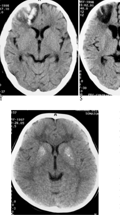 Fig. 3. 9.6-year-old female patient with acute lymphoblastic leukemia A.  Follow-up CT shows hyperdense area suggesting intracerebral  hemor-rhage in the right frontal lobe after 6months from the diagnosis.