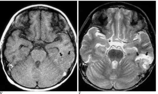 Fig. 5. 4.9-year-old female patient with subacute hemorrhagic infarction which occurred during induction chemotherapy for acute lymphoblastic leukemia