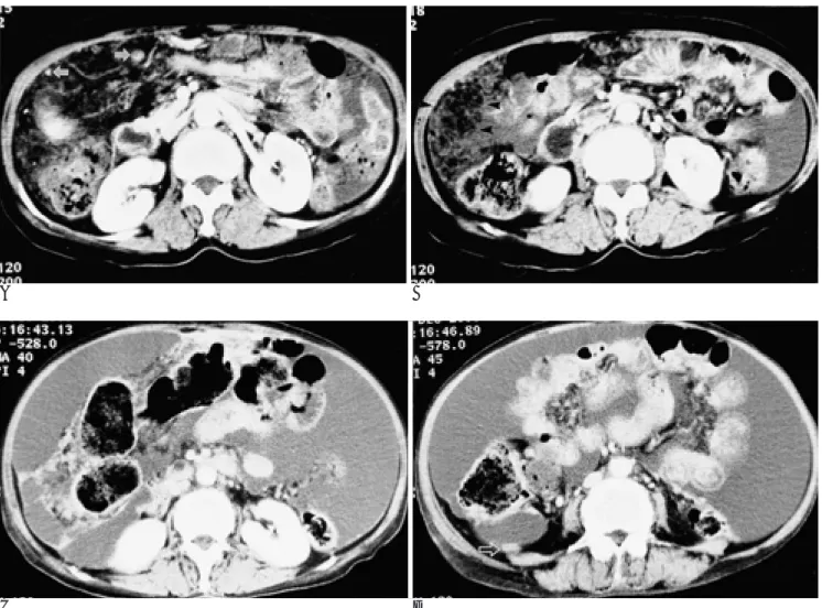 Fig. 1. A, B. Initial CT scans.