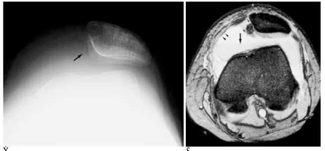 Fig. 2. A 15-year-old girl with trauma on left knee by fall down.