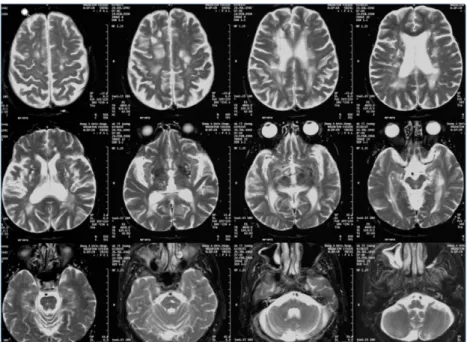Fig.  2.  Brain  MRI  T2  images  show  multiple  lacunar  infarction  with  moderate  white  matter  changes