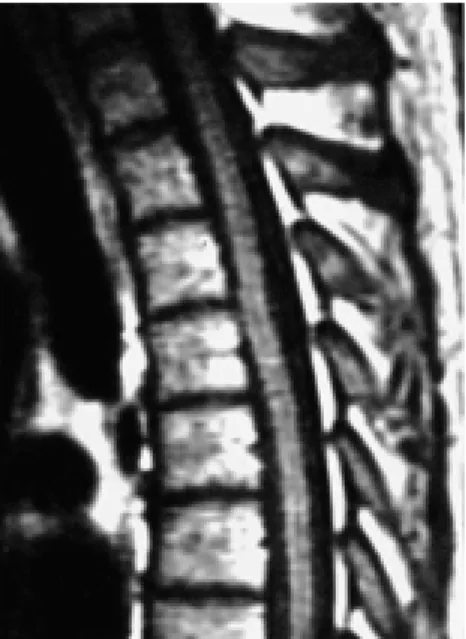 Fig. 3. Computed tomographic myelogram shows the anterior displacement of the spinal cord and tongue-like projection of the spinal cord through ventrolateral dural defect.