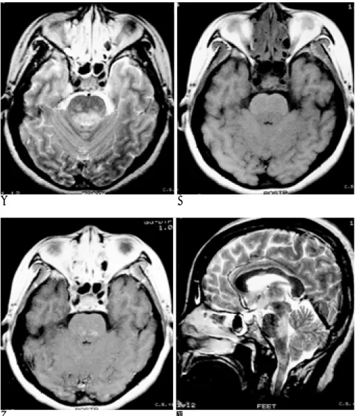 Fig. 2. A 39-year-old female with seizure, dizziness and nystagmus (Case 16).