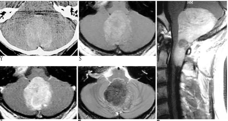 Fig. 1. 27-year-old man with primary leptomeningeal malignant melanoma in the posterior fossa and upper cervical spinal canal.