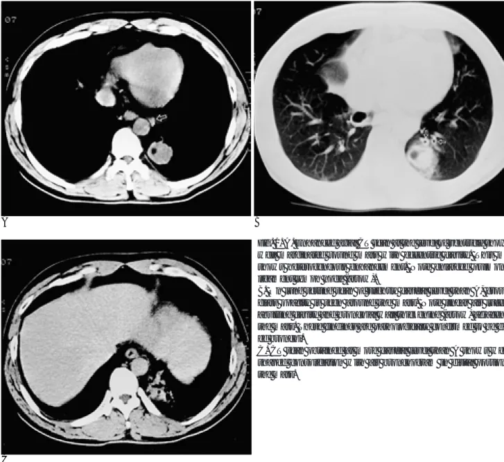 Fig. 1. A. Enhanced axial CT scan at the level of ventricle shows a well marginated round mass with eccentric cavity