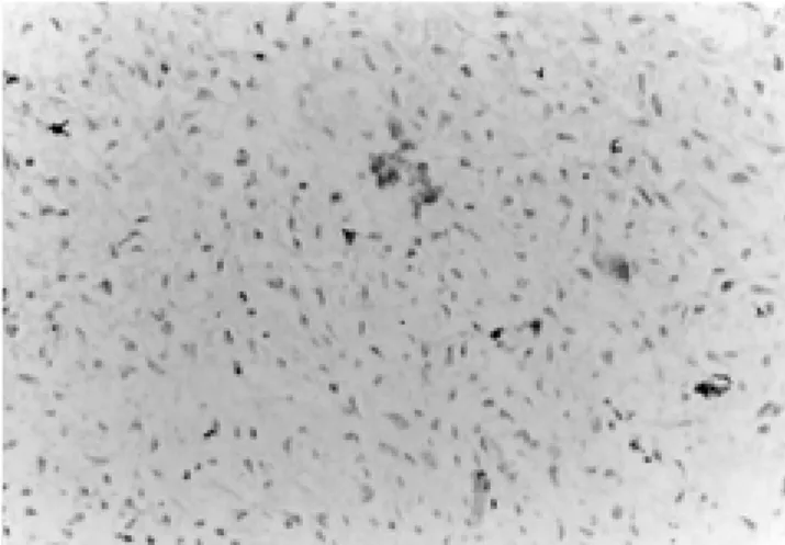 Fig. 3. Some tumor cells react for S-100 protein (PAS, ×40).