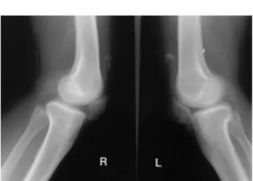 Fig. 2. Lateral radiographs of the both knees demonstrate low lying patellae with irregular shaped calcifications in the  supra-patellar soft tissues