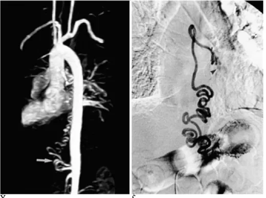 Fig. 3. A. Contrast enhanced MR an- an-giography before bronchial artery  em-bolization