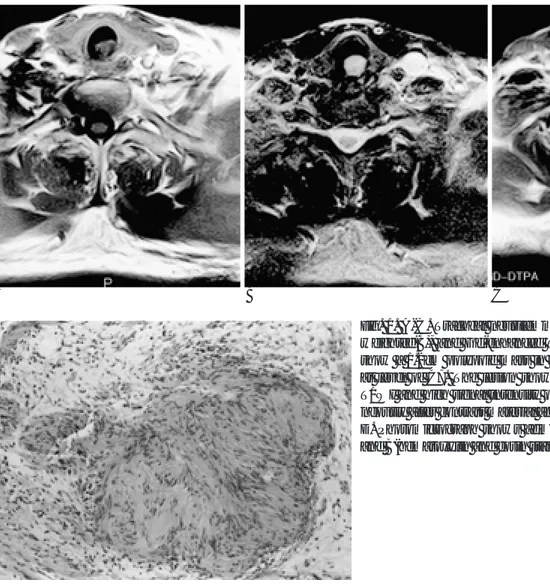 Fig. 1. A-C. Tracheal neurilemmoma. Axial T1 weighted(A), T2 weighted(B), and Gd-enhanced T1 weighted(C) images of neck show a 1.2cm polypoid mass in the posterior wall of the trachea at level of C7