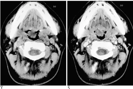 Fig. 2. Tongue base neurilemmoma.