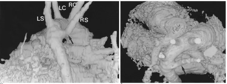 Fig. 1. Left aortic arch with aberrant right subclavian artery in a 2-year-old boy.