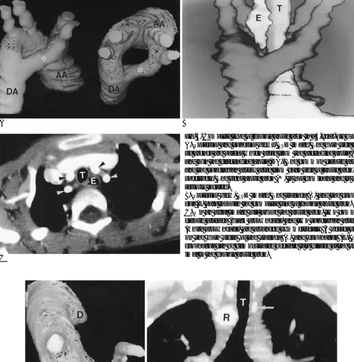 Fig. 4. Complete type of double aortic arch in a 4-year-old boy. 
