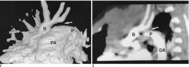 Fig. 10. Interruption of aortic arch, type A in a 11-day-old boy.