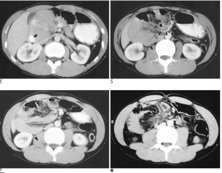 Fig. 1. Twenty-two-year-old man presenting with acute small bowel obstruction due to right paraduodenal hernia