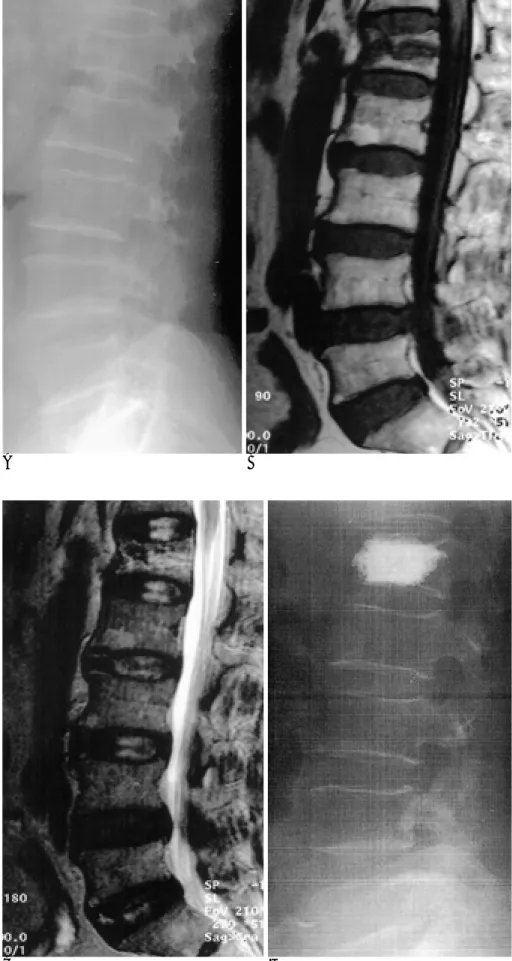 Fig. 3. A 67 years old woman with se- se-vere lower back pain shows subtle buckling of L1 vertebral body on  sim-ple radiography (A), low signal  intensi-ty on T1WI (B) and high signal intensiintensi-ty on T2WI (C)
