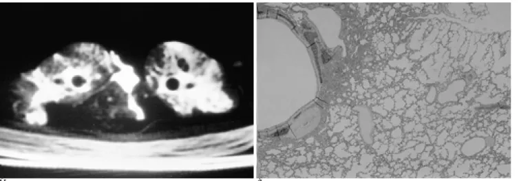 Fig. 1. A. High-resolution CT finding of 2-hour group. HRCT scan shows bilateral ground glass opacity, patchy consolidation with air bronchogram, and thickening of bronchovascular bundle.