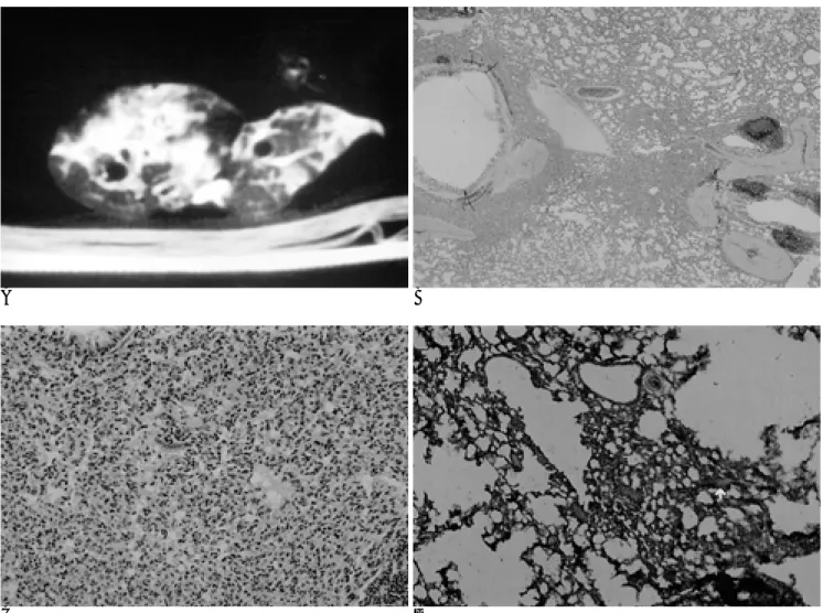 Fig. 2. A. High-resolutin CT finding of 24-hour group. HRCT scan shows bilateral multiple consolidations with ground glass opaci- opaci-ty