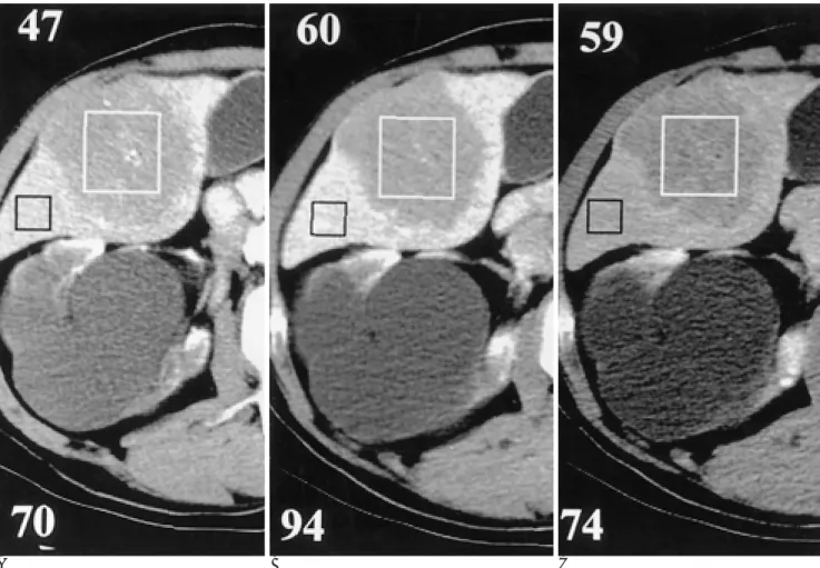 Fig. 1. Triphasic liver CT scan of HCC with homogeneous attenuation. A.  arterial,  B