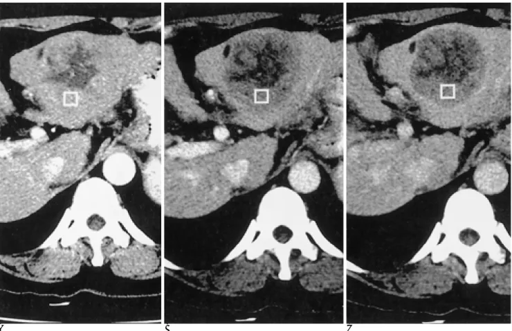 Fig. 2. Triphasic liver CT scan of HCC with heterogeneous attenuation. A.  arterial,  B