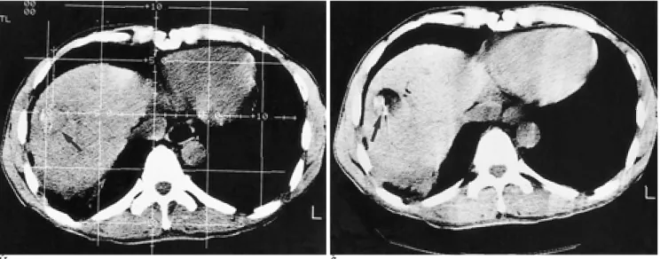 Fig. 1. Targeting process of CT-guided PEIT. 