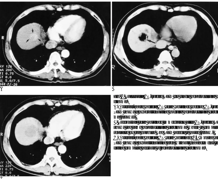 Fig. 2. Successful CT-guided PEIT for single hepatocellular car- car-cinoma.