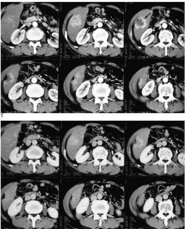 Fig. 1. 57-year-old man with cholangiocarcinoma in the hepatic segment 5 (skipped image)