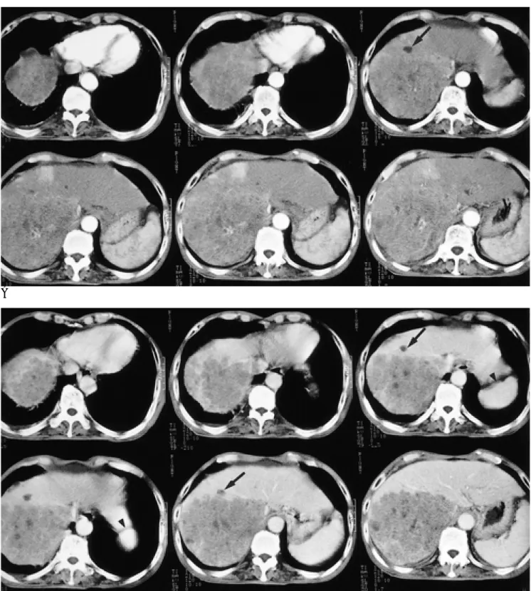Fig. 3. 76-year-old man with a single hepatic nodule in the hepatic segment 4 (overlapped image)