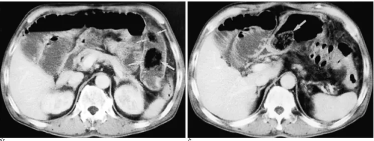 Fig. 1. 56-year-old man with small intestinal obstruction due to phytobezoar after endoscopic fragmentation of gastric phytobezoar.