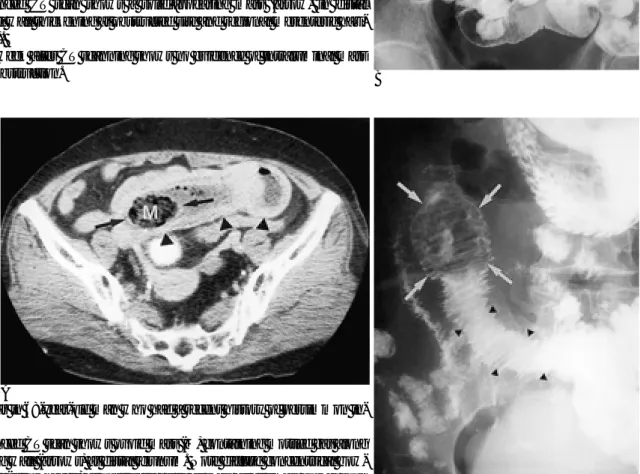 Fig. 3. Phytobezoar in 68-year-old man who had a recent history of persimmon in- in-gestion.