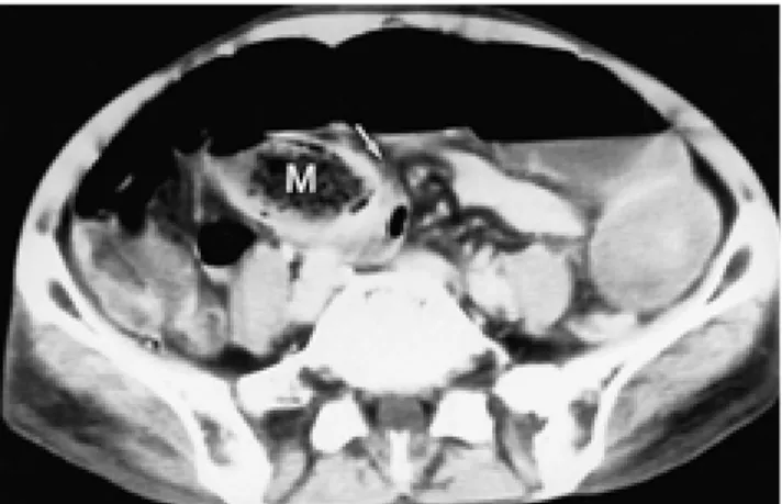 Fig. 5. 62-year-old woman with phytobezoar associated with tu- tu-berculous strictures.