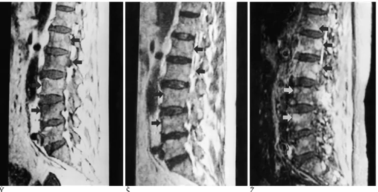 Fig. 1. Multiple myeloma with focal pattern in a 60-year-old man. 