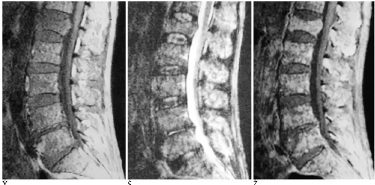Fig. 3. Multiple myeloma with  ‘salt &amp; pepper’pattern in a 59-years-old man. 