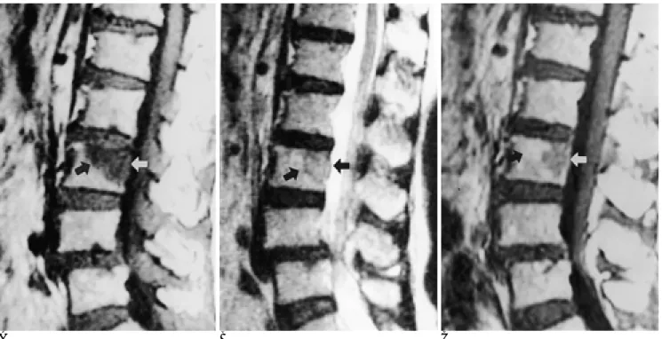 Fig. 5. Metastasis with focal pattern in a 74-years-old woman.