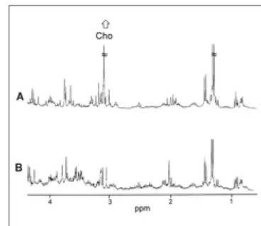 Fig. 3. In vitro  1 H MR spectra of carcinoma (A) and normal breast tissue (B). Note that in vitro MRS detected almost all the metabolites including choline from the samples, whereas in  vi-vo MRS (fig