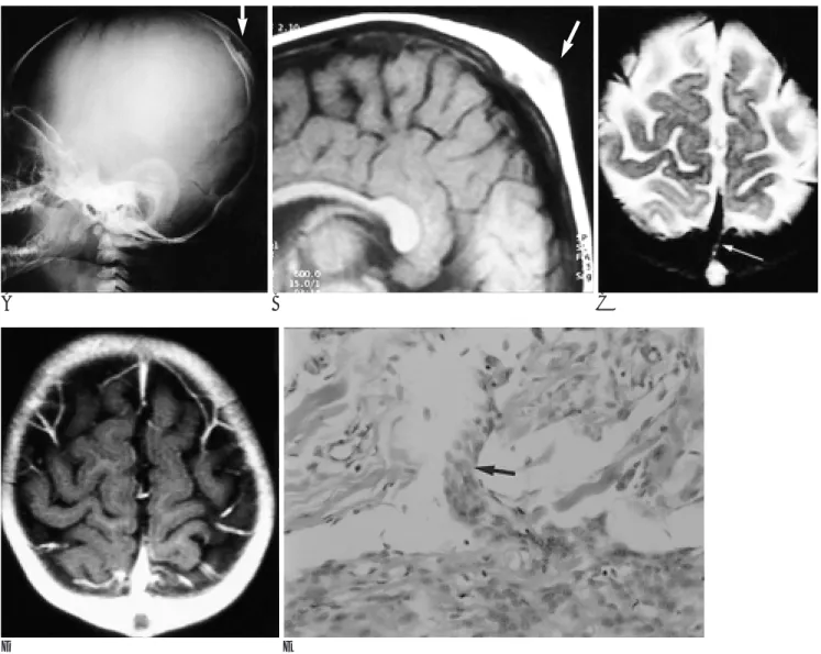 Fig. 1. Primary cutaneous meningioma at scalp