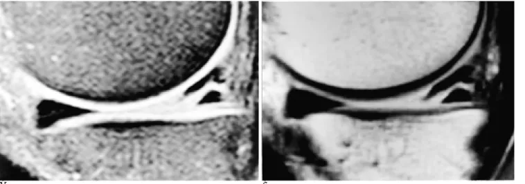 Fig. 1. Sagittal knee MR image in 41-year-old man with knee pain