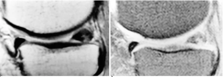 Fig. 3. Sagittal knee MR image in 36-year-old man with knee pain
