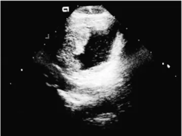 Fig. 3. MR performed 1 1/2 years after initial US and CT. T1-weighted axial scan (A) shows diffuse and irregular thickening of the urinary bladder wall with heterogeneous low signal intensity