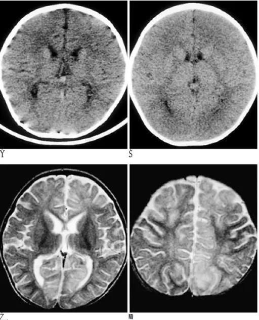 Fig. 1. A. Precontrast CT scan shows diffuse low attenuation with loss of gray and white matter differentiation.