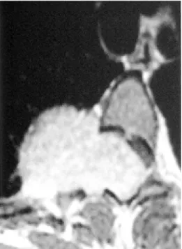 Fig. 7. A 13-year-old boy with cervical neurofibromas