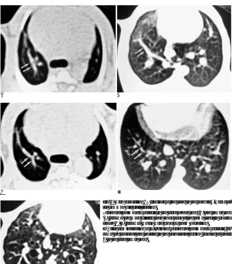 Fig. 1. High resolution CT findings of the lung in the rabbits 3-weeks af- af-ter common bile duct ligation