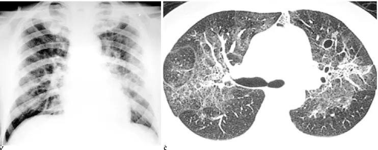Table 2. Pattern Approach of Chest Radiographs in Available 63 Admission Cases of HIV-Postive Patients