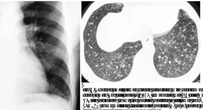 Fig. 4. Primary tuberculosis with 20 CD4+ cells/mm 3 in-43-year old man.