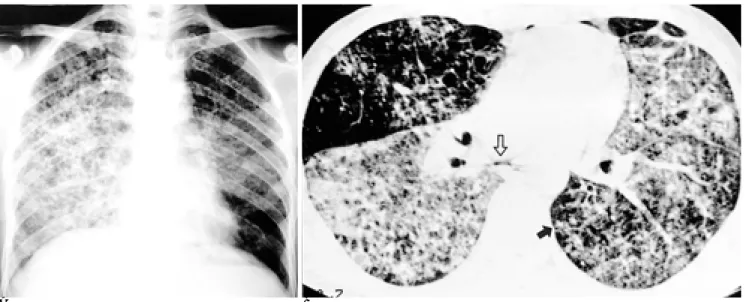 Fig. 6. Combined infection of PCP and tuberculosis with 222 CD4+ cells/mm 3 in 37-year-old man.