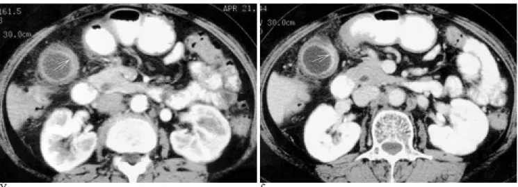 Table 1. Enhancement Patterns of Wall Thickening in Gallbladder Carcinoma and Cholecystitis