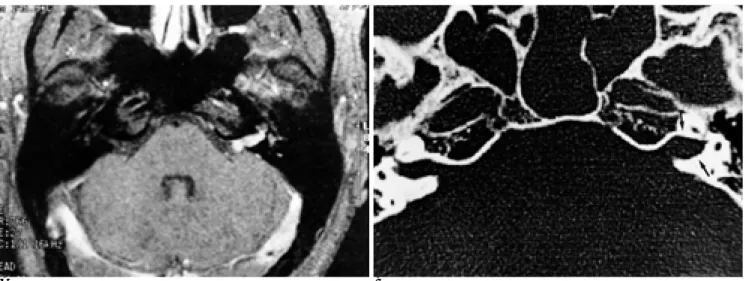 Fig. 1. A 25 year-old man with facial nerve schwannoma involving left intracanalicular segment and cisternal segment (case 3)
