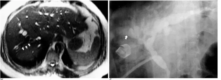 Fig. 1. 56 -year-old female with symptoms of cholangitis