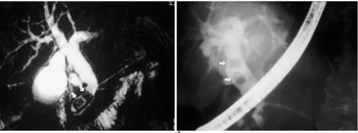 Fig. 3. Small gall bladder stones not visible on projection image A. Projection image shows no low signal intensity stone in the nondilated extrahepatic and gall bladder lumen.