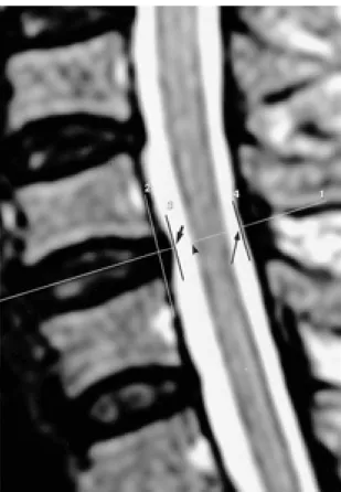 Fig. 1. Methods of the measurements of the bulging thickness(line 2 to short arrow), AP diameter of spinal canal(short arrow to long arrow), and distance between the margins of disk and spinal cord(short arrow to arrowhead) at each level of the disk on the